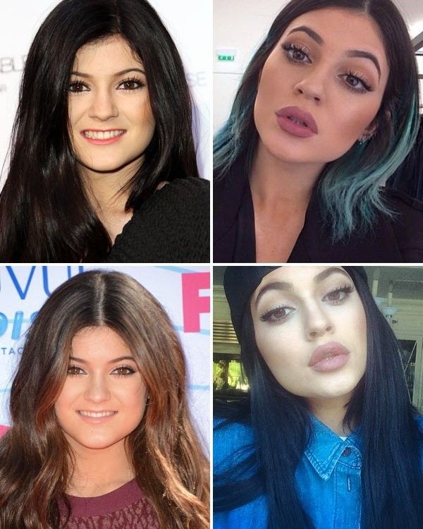 Kylies+lip+transformation